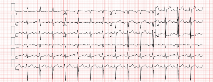 AI-Powered Diagnostics Uncover Hidden Heart Conditions: A Case Study in Emergency Medicine